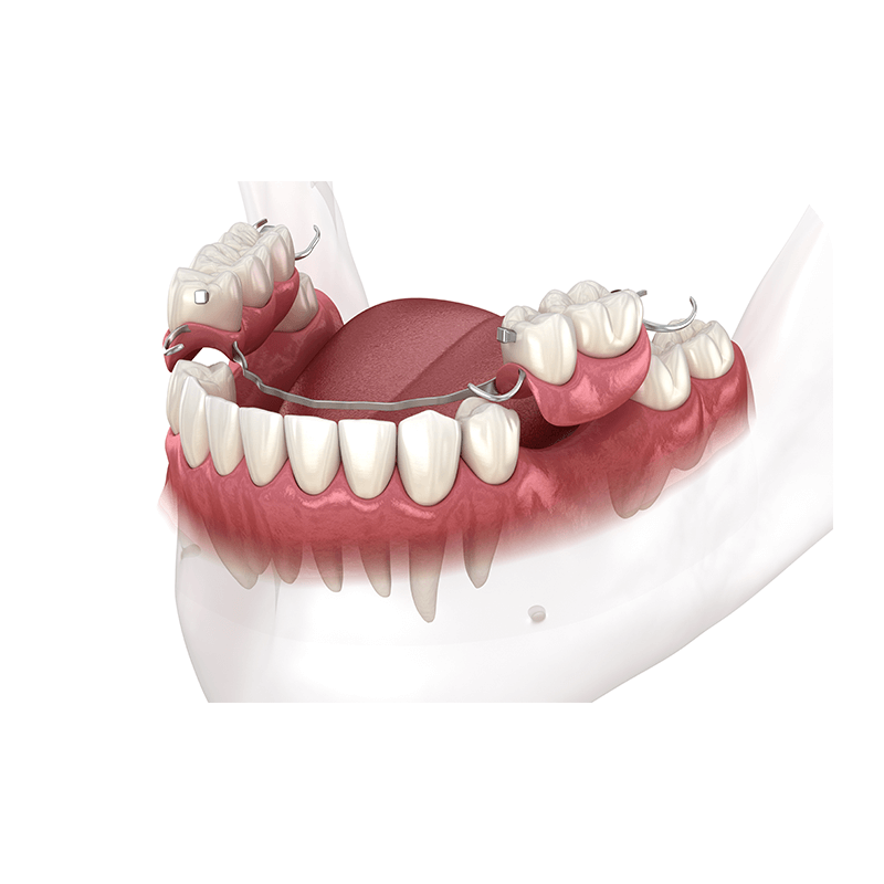 3D illustration of a partial denture.