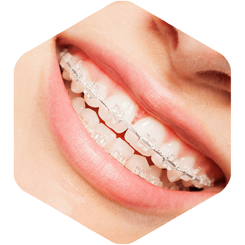 Ceramic Braces on a patient.