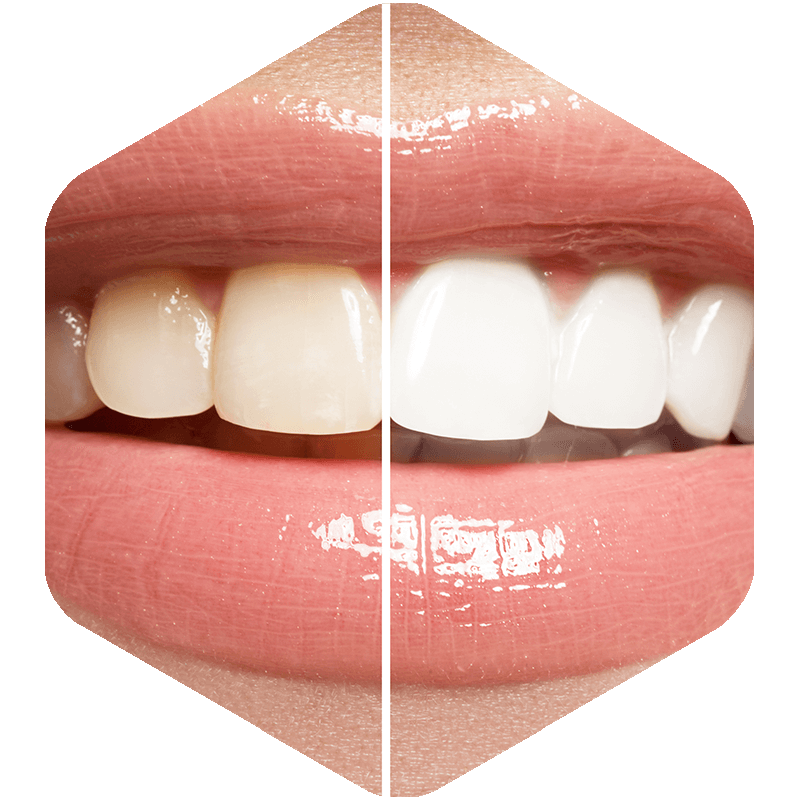 Smile comparison showing half white teeth and half yellow teeth.