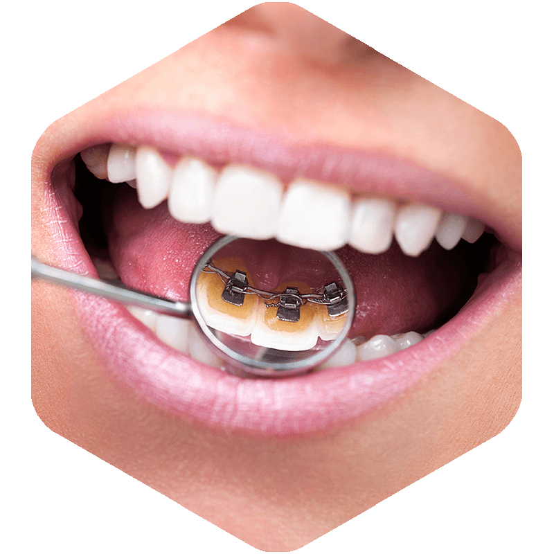 Lingual braces on a patient.