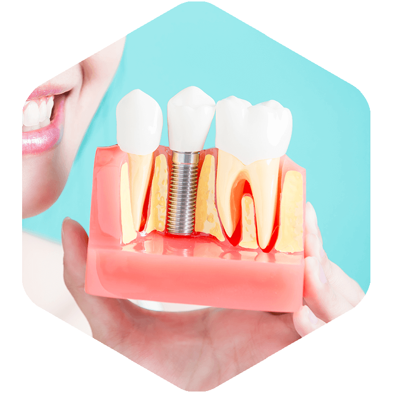 Denture model displaying a dental implant.