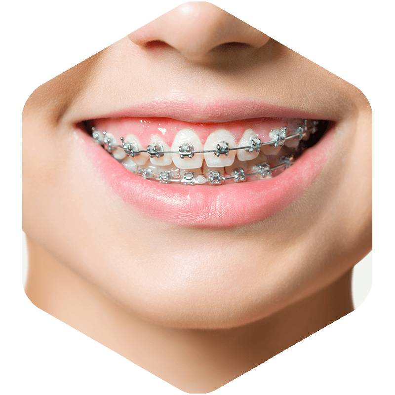 Metal Braces on a patient.