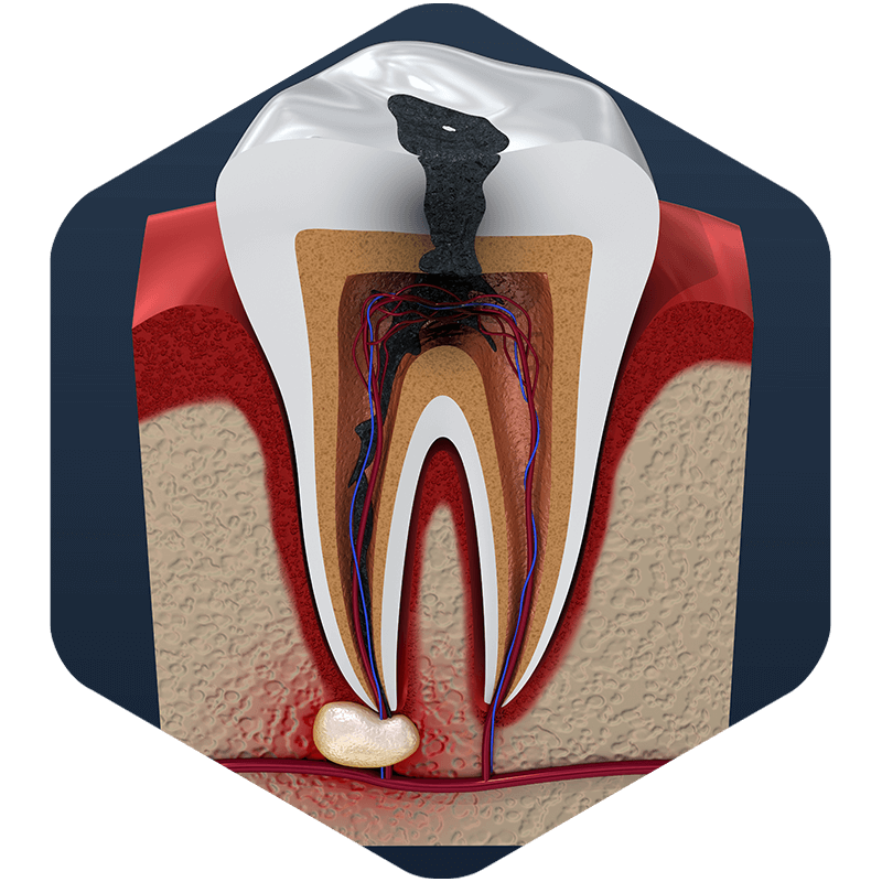 3D illustration showing internal tooth decay.