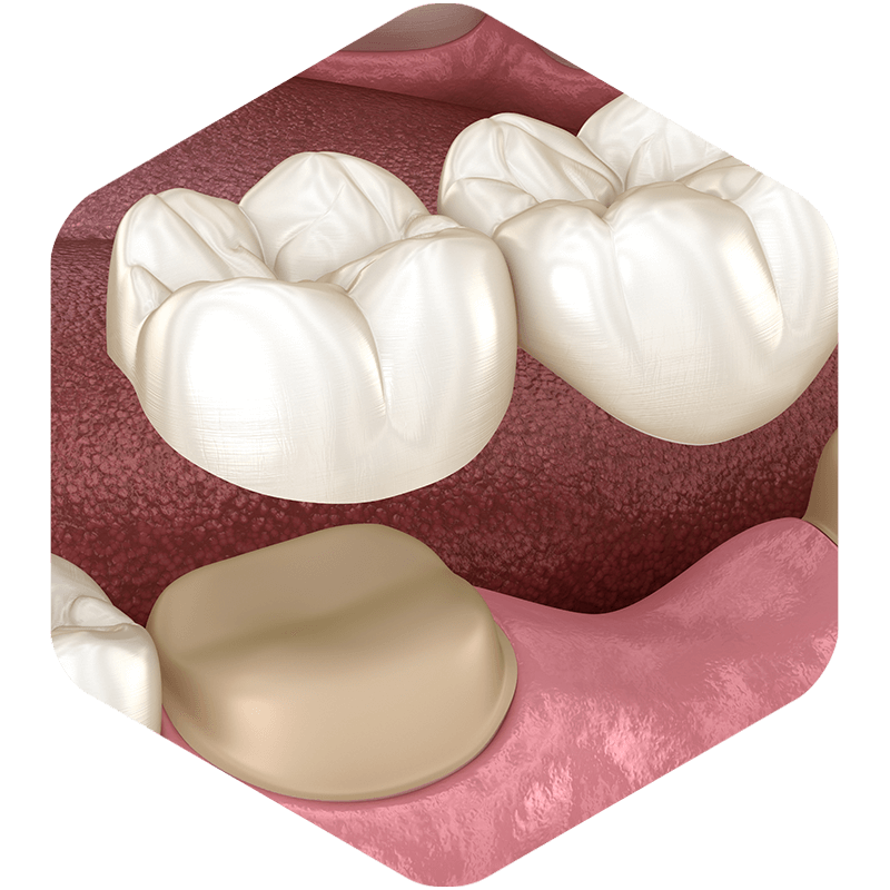 A 3D dental crown being placed.