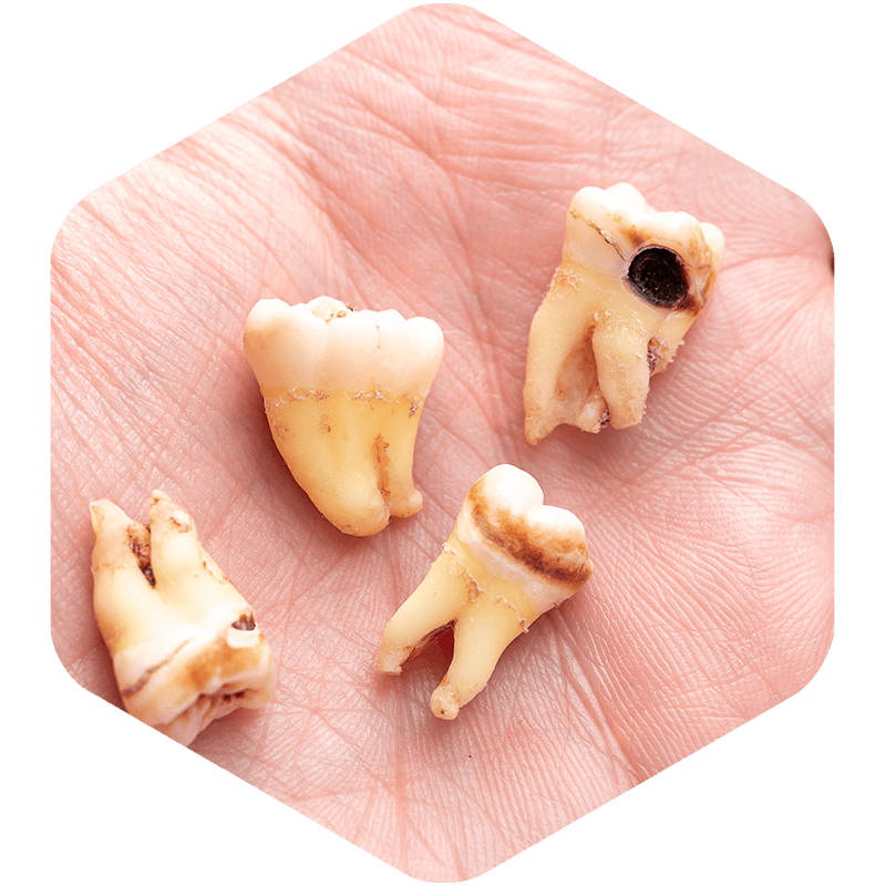 Extracted teeth showing signs of decay.