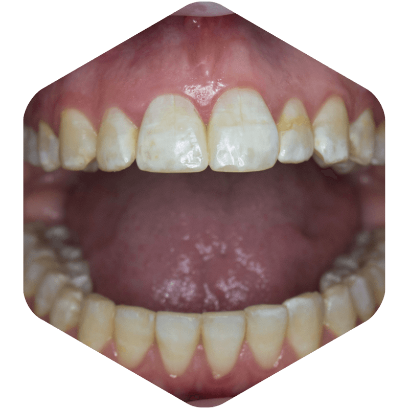 Close-up of stained teeth.