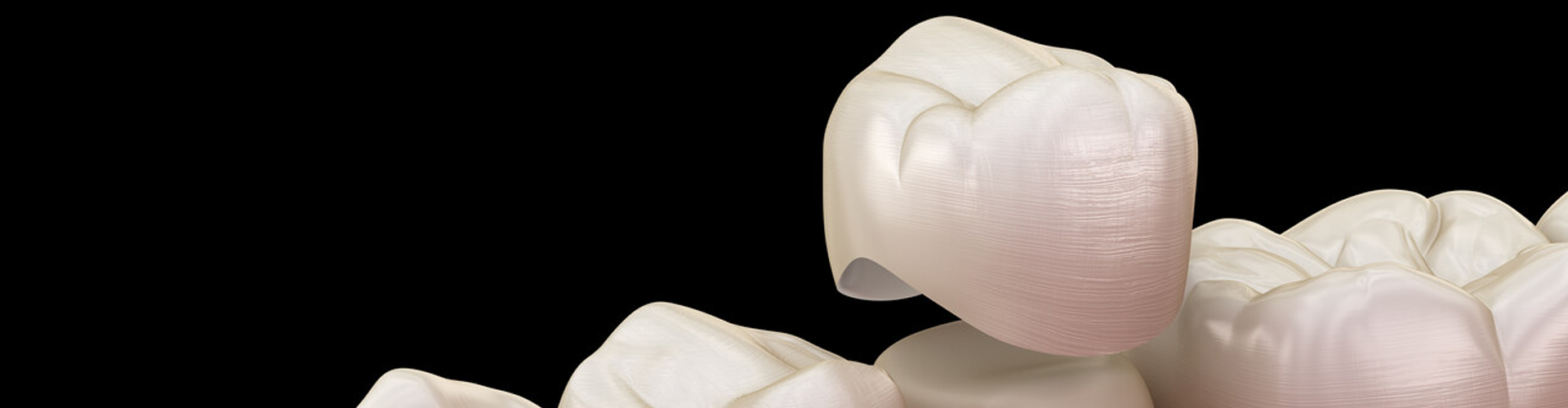 rendering of crown being placed on a tooth