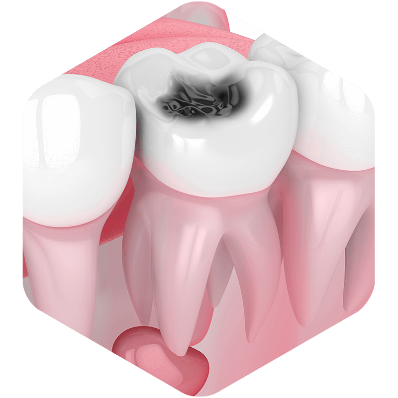 3D illustration showing a dental cavity in a tooth.